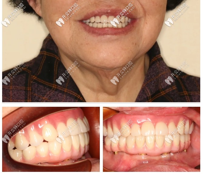 全口没牙在成都做微创种植牙后,觉得极光口腔挺正规靠谱滴