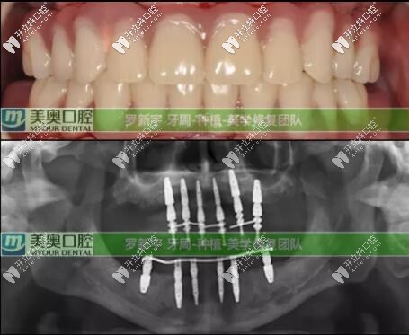 无锡美奥口腔牙周炎种植6个月后口内情况