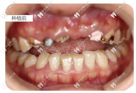 种植牙前的牙齿情况