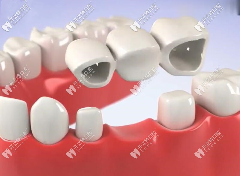 牙齿搭桥是什么样子的