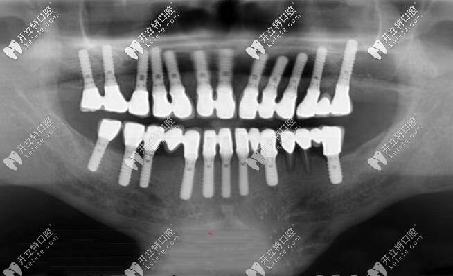 传统的全口种植牙X光片