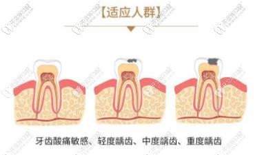 3M补牙适宜人群 3M补牙适宜人群
