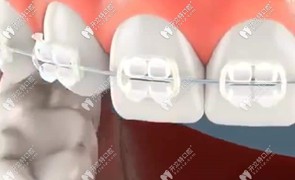 3M陶瓷自锁托槽的价格... 3M陶瓷自锁托槽的价格...
