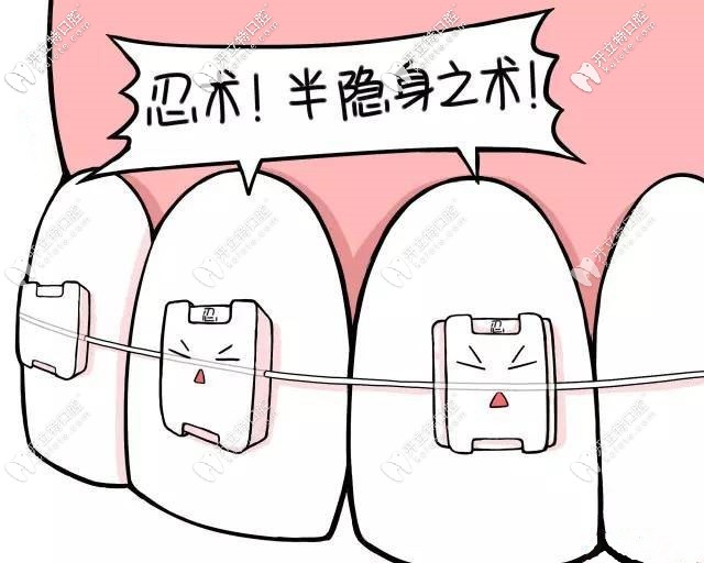 透明陶瓷矫正牙套