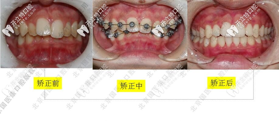 北京国医康口腔孩子深覆合加深覆盖挺好矫正的,选的是OBrace球面自锁托槽