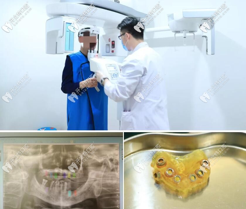 张大爷种牙前的CBCT检查和3D数字化导板