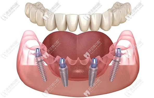 All-on-4种植修复技术