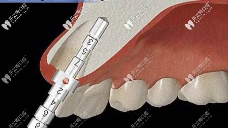 即刻种植对骨量是有一定要求的