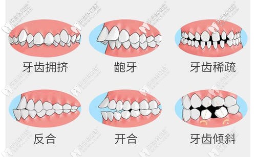 牙齿矫正适应症