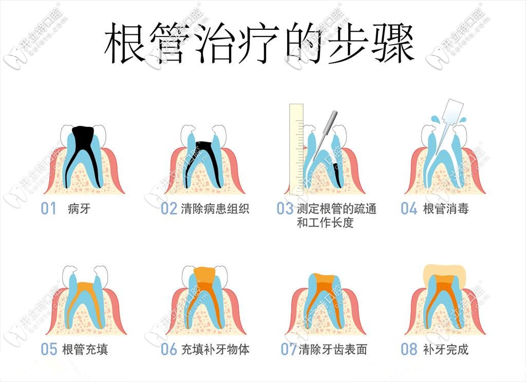 根管治疗详细过程