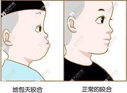 儿童地包天和正常的咬合对比 儿童地包天和正常的咬合对比
