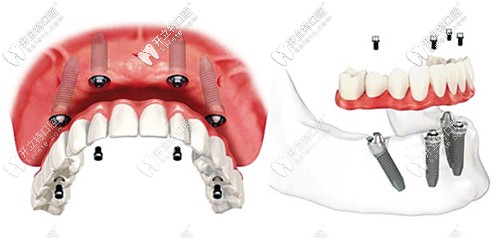 ALL-on-4种植牙技术解析