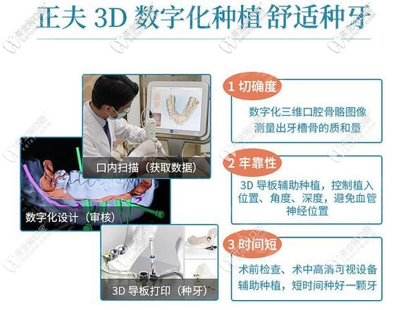 深圳正夫口腔数字化3D导板种植牙