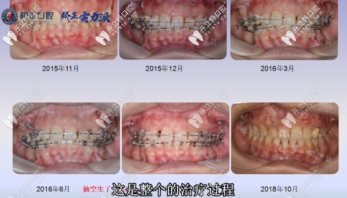 南宁柏乐后牙缺失三颗大牙案例整个治疗过程