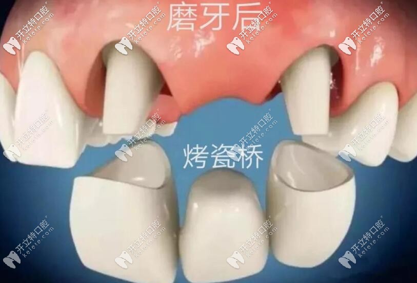 缺牙修复烤瓷桥 缺牙修复烤瓷桥