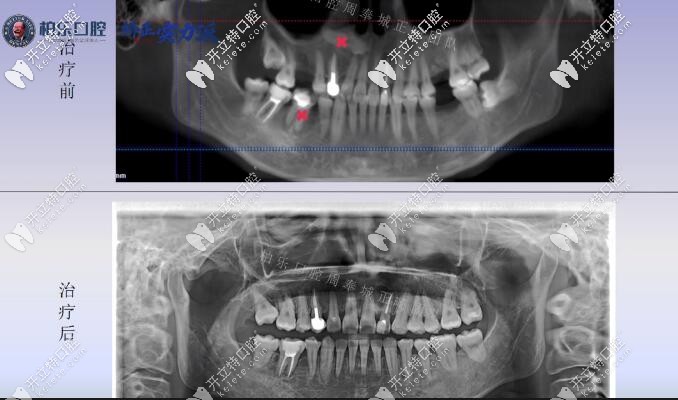 南宁柏乐口腔缺失三颗矫正案例X线片前后对比