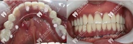 3d导板all-on-6即刻种植牙当天恢复全口,价格10多万是有道理的 
