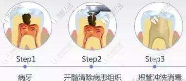 根管治疗的意义