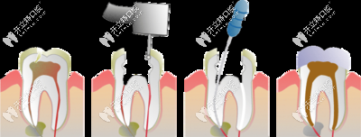 根管治疗的过程