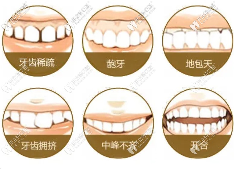 牙齿不齐的类型