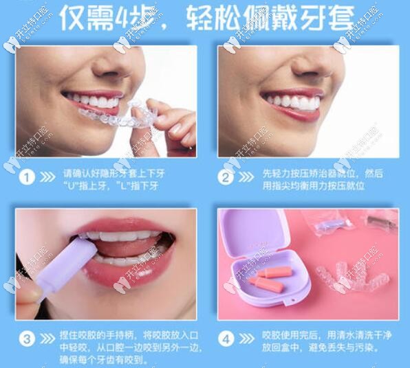 厦门峰煜口腔隐适美牙套