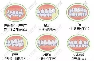 钢牙套针对病例更广