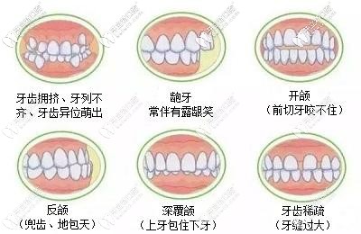 钢牙套针对病例更广