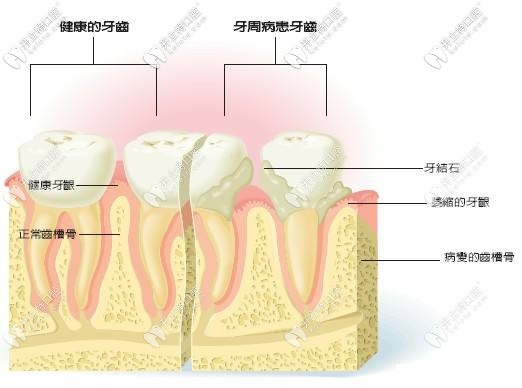 正常的牙槽骨和牙周病的牙槽骨