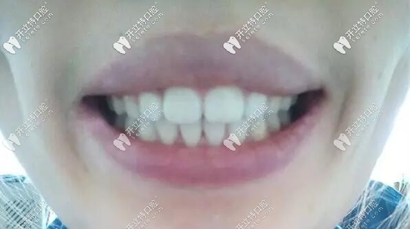 我在厦门峰煜口腔做龅牙矫正后的效果