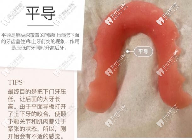 牙齿矫正平导的作用 牙齿矫正平导的作用
