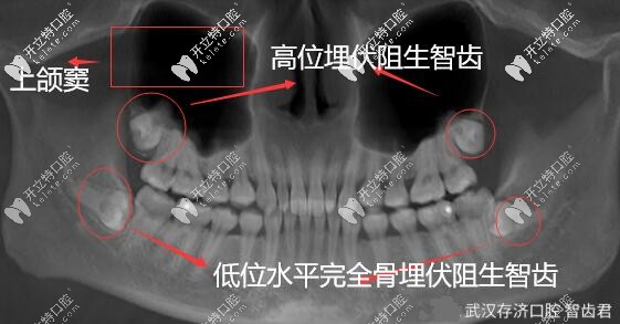 武汉拔牙案例|超声骨刀微创拔除埋伏阻生智齿,详解过程图解