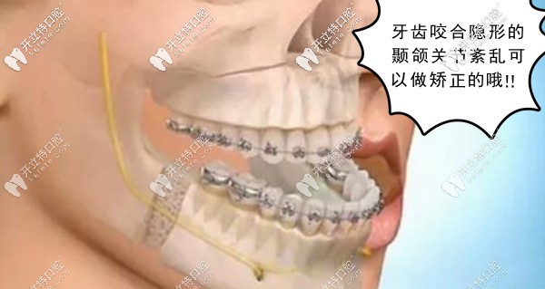 颞下颌关节紊乱能做牙齿矫正吗