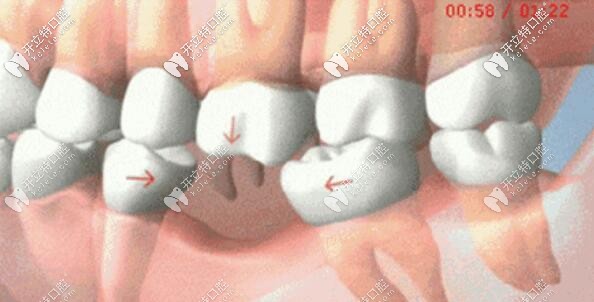 牙齿缺失的危害邻牙倾倒