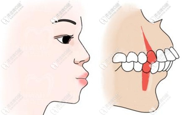 口腔正颌需要正畸和正颌医生联合会诊