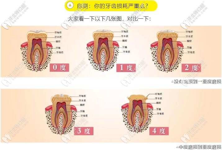 牙齿磨耗的程度