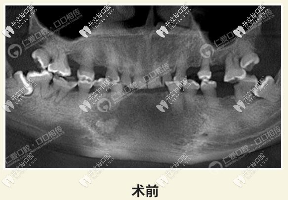 武汉仁爱口腔牙齿磨耗治疗<span style=