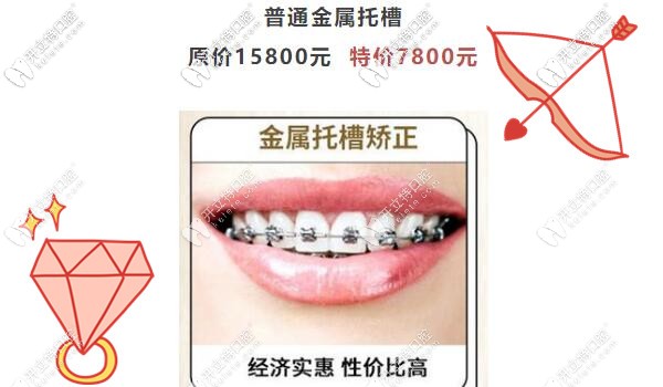 广州圣贝传统金属托槽矫正才7800元啦,暑假正畸不造起来吗？