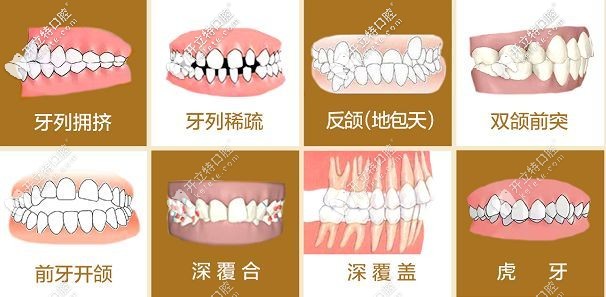 牙齿畸形的程度不同