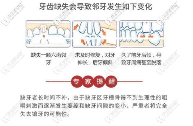 尹静波主任提醒，长时间缺牙危害很大