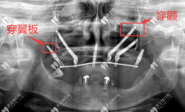 深圳正夫口腔熊靖宇穿颧穿翼板种植牙案例