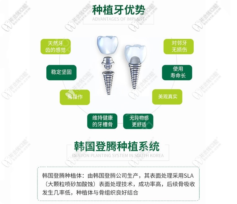 韩国登腾种植牙怎么样