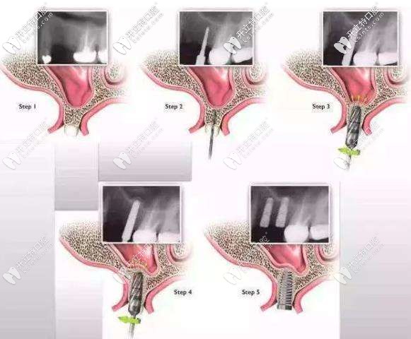 上颌窦提升术植入种植体过程