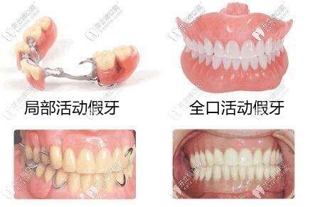 全口活动假牙和半口活动假牙