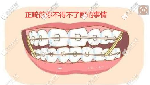 正畸前需要知道的事情 正畸前需要知道的事情