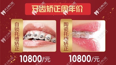 陶瓷托槽和金属自锁托槽价格 陶瓷托槽和金属自锁托槽价格