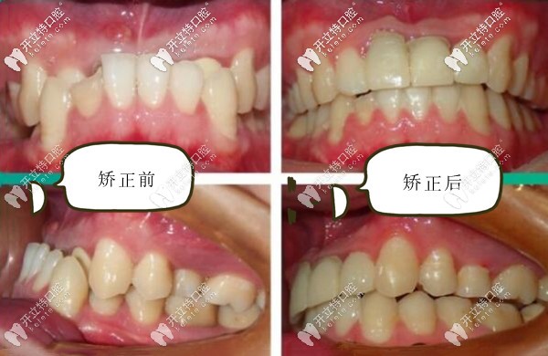 深圳登特口腔地包天牙齿矫正前后对比照片