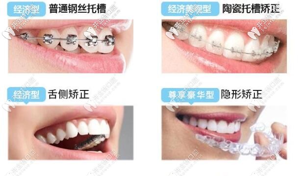 牙套种类 牙套种类