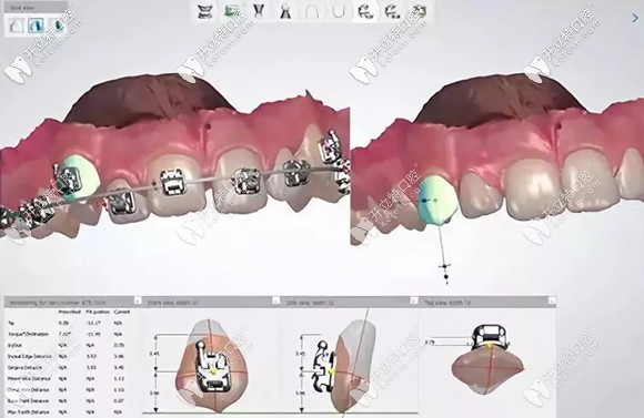 广州柏德3D口扫的效果图
