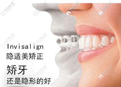 隐适美隐形牙套
