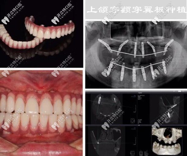 我在深圳登缇斯口腔做穿颧穿翼板种植牙后的效果 我在深圳登缇斯口腔做穿颧穿翼板种植牙后的效果